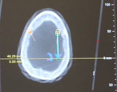 Brain scan during DBS procedure.
